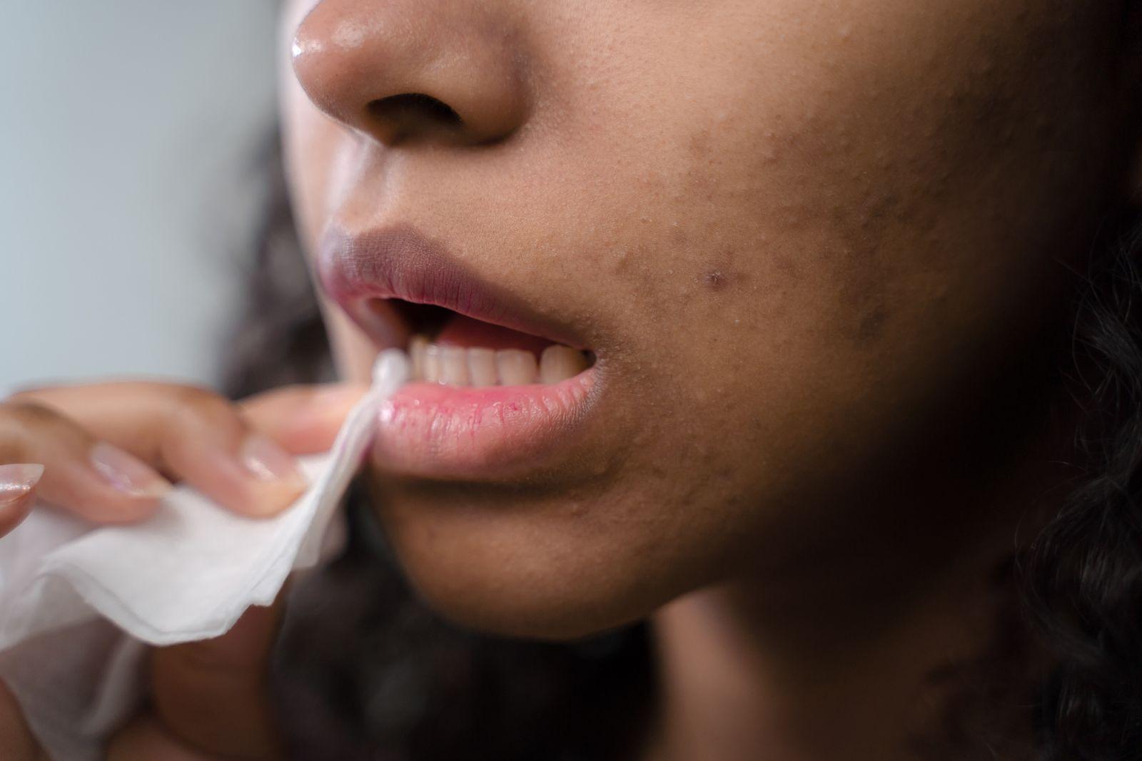 Close-up of skin showing post-acne marks and uneven texture on the cheek