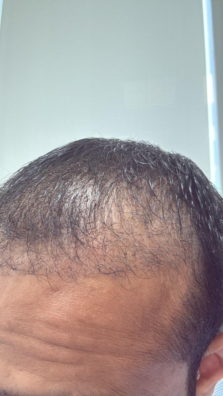 Three-quarter view of the same patient hairline three months after exosome hair therapy