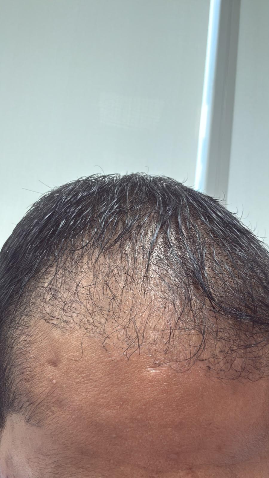 Front view of the same patient hairline three months after exosome hair therapy, hair damp