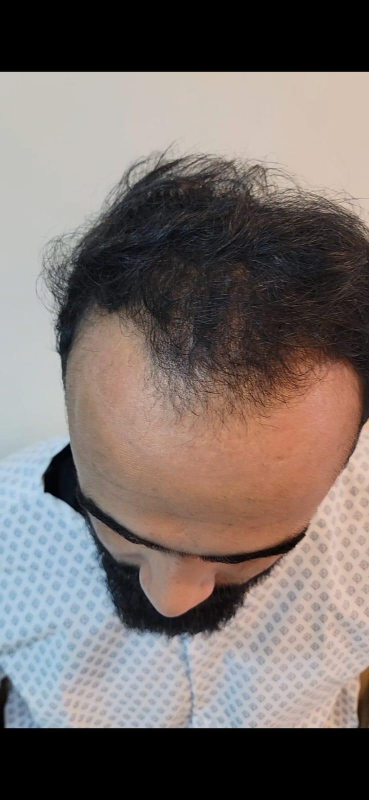 Top-down view of a male scalp before exosome hair therapy, showing thinning through the frontal region
